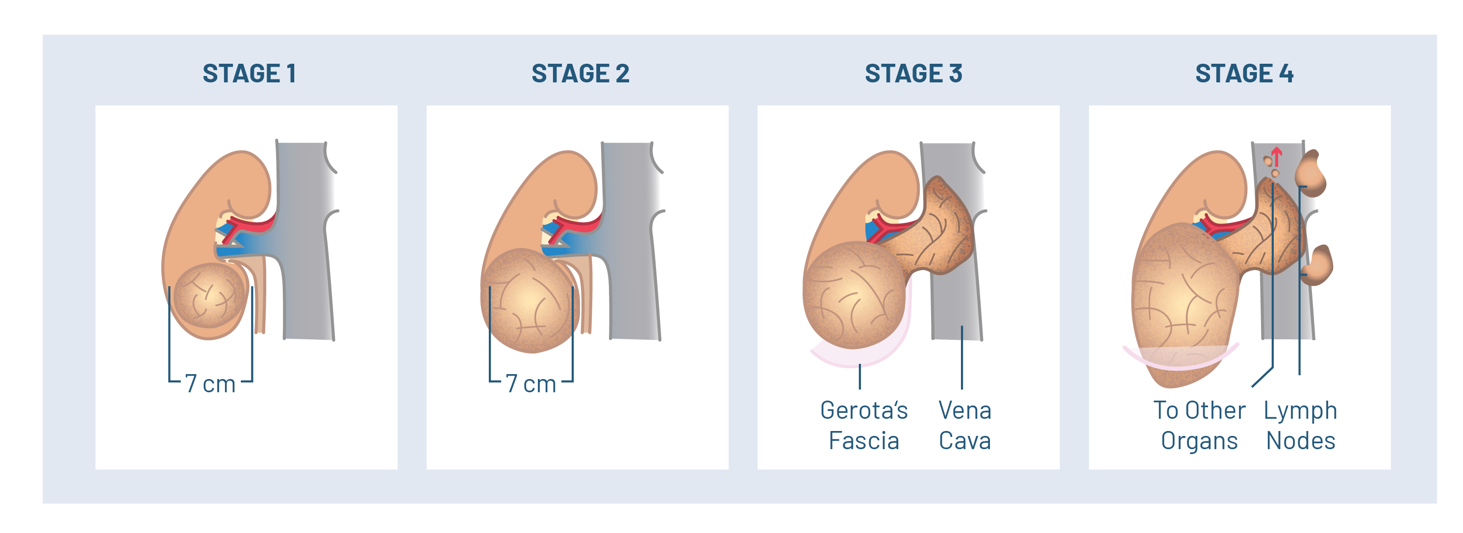 COMFORT_website_graphics_renal-cancer.png