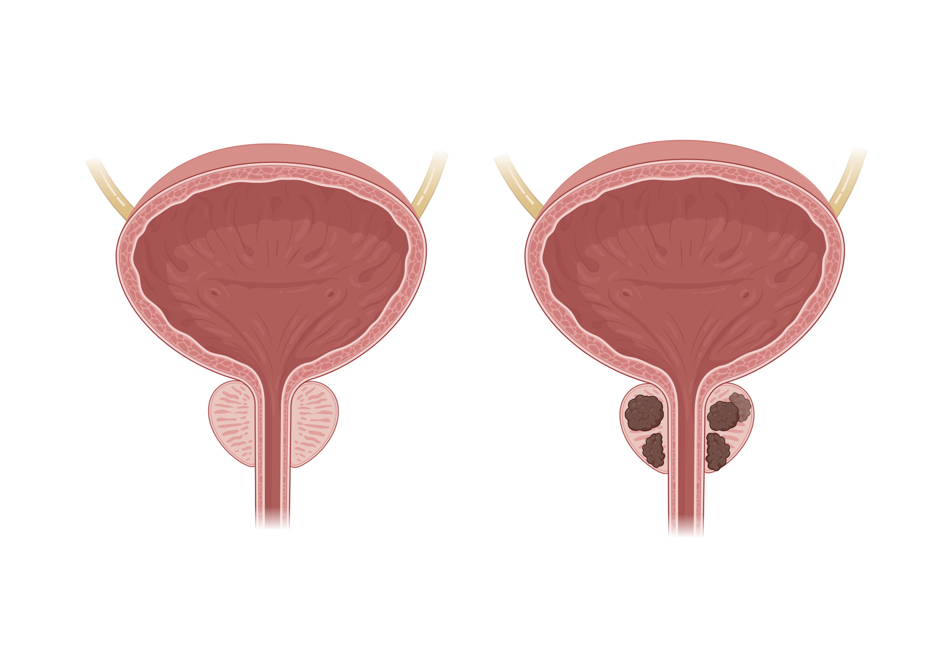 Healthy Prostate on the left and Prostate with cancer on the right