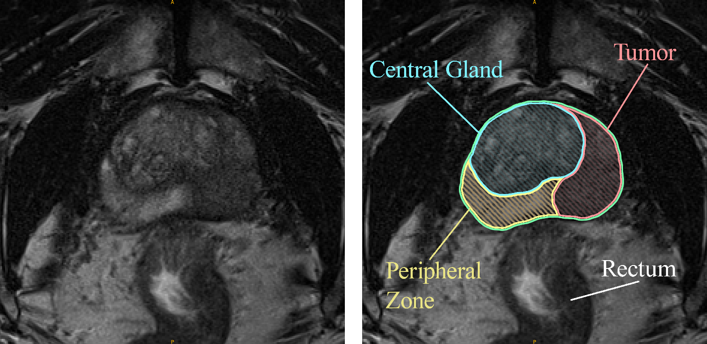 MRI Scan of prostate