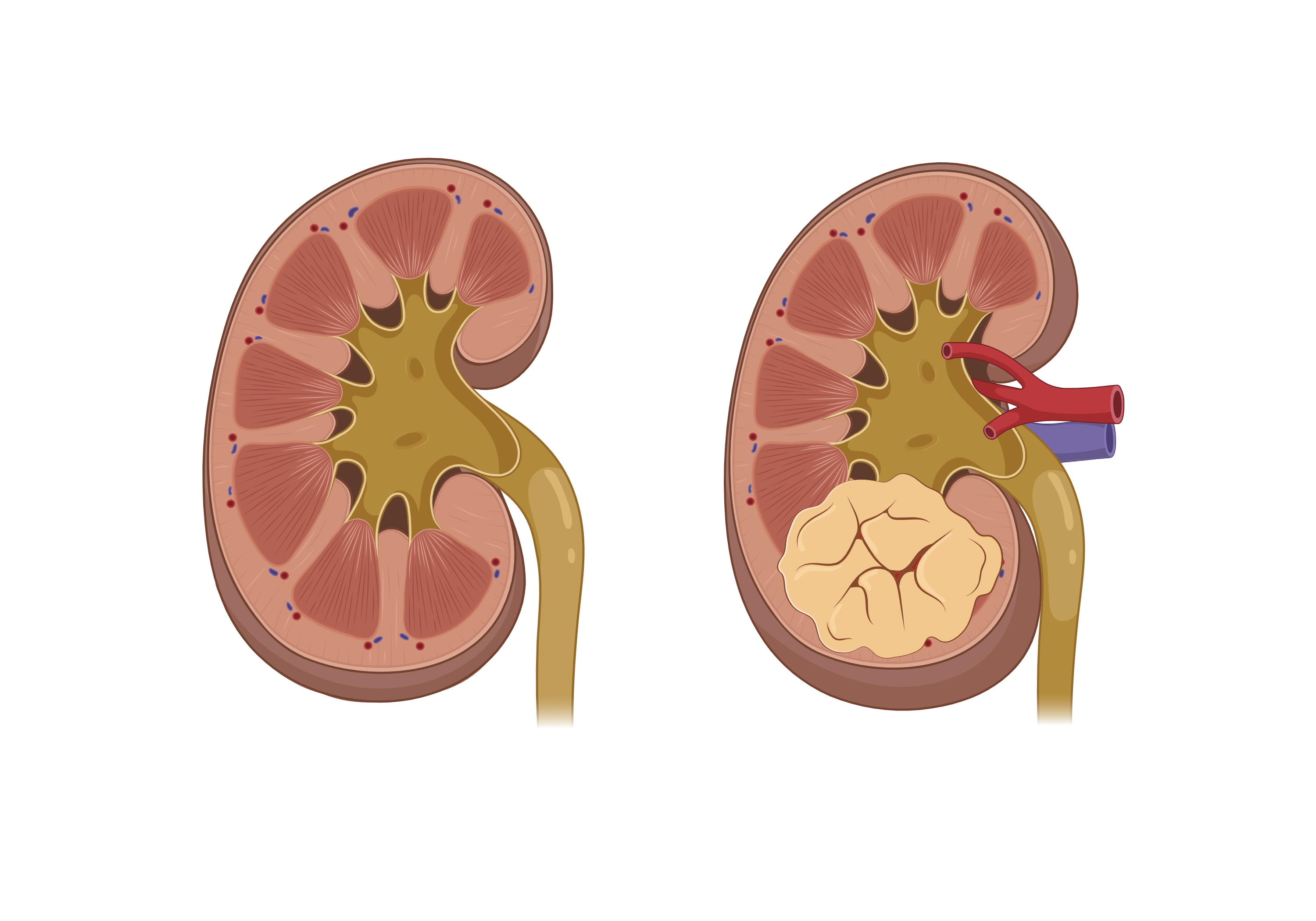 Healthy Kidney on the left and Kidney with cancer on the right