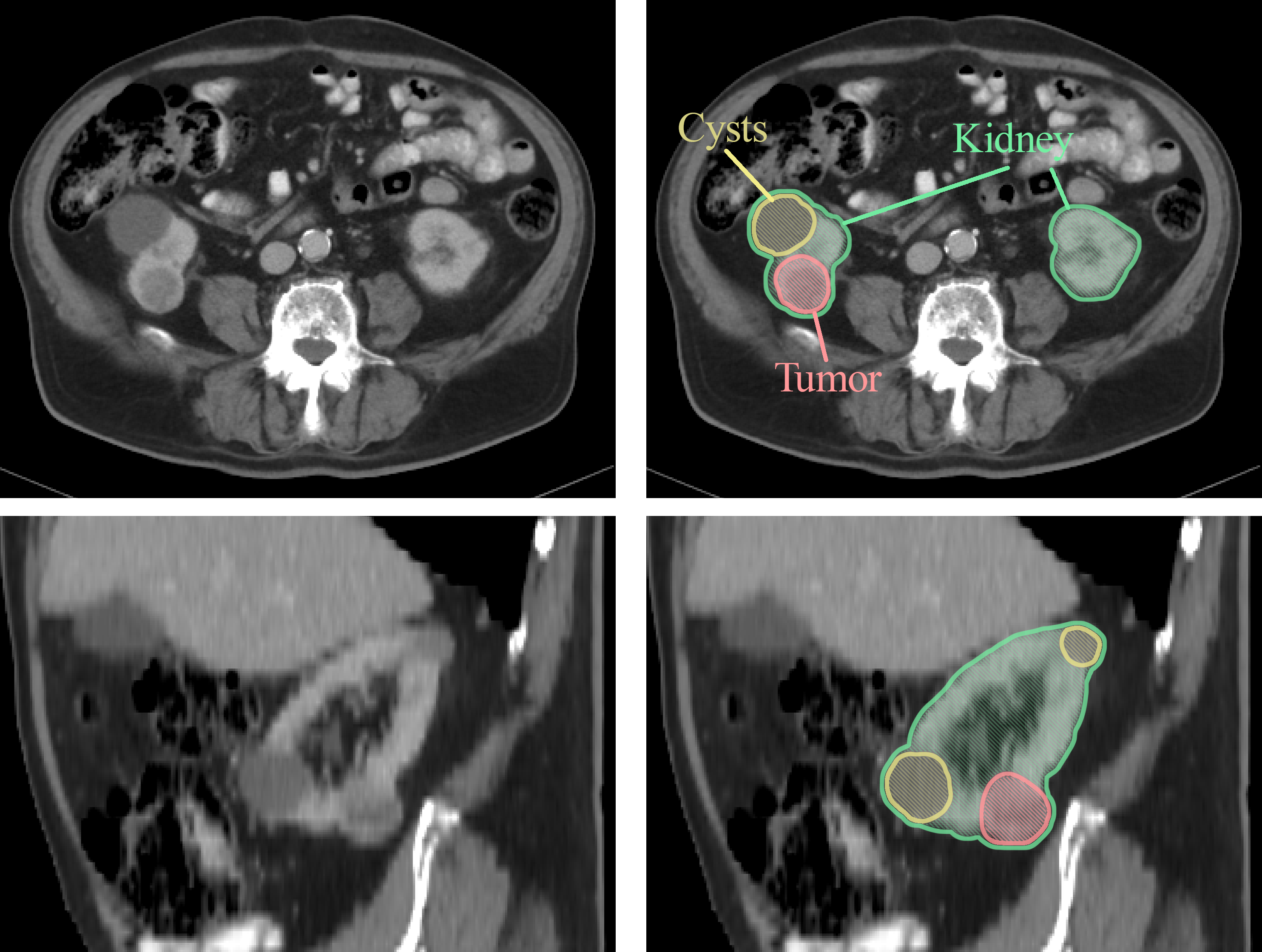 CT scan or MRI image of kidney